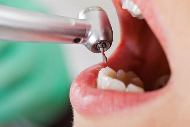 Best Emergency Root Canal Therapy in Queensland, MD